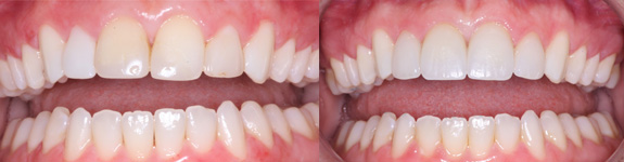 2 Veneers and 2 Crowns