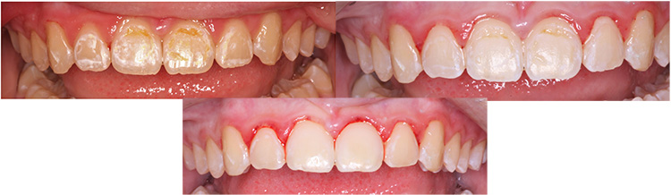 Spot removal and composite bonding