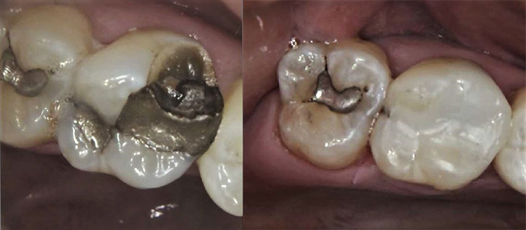 Emergency Fractured Tooth Repair